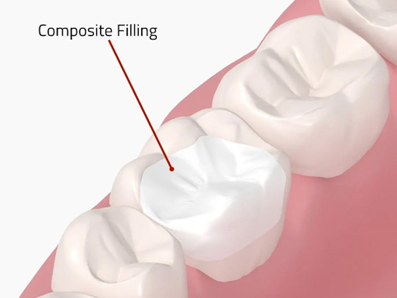 Composite Fillings Grandville Mi Dentists