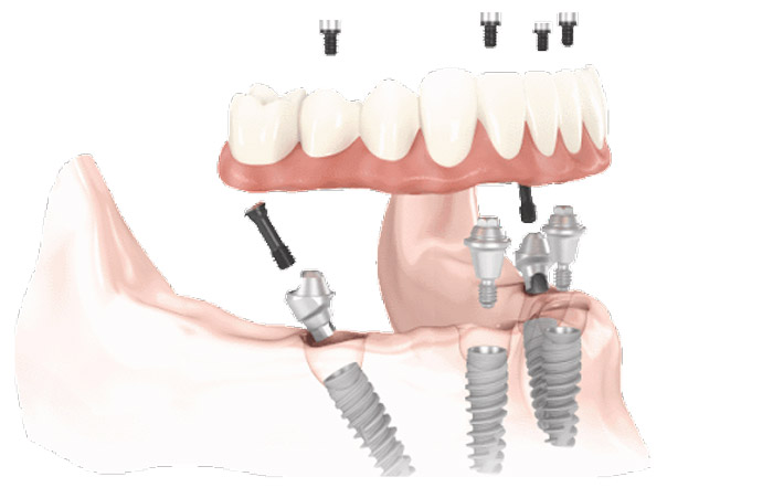 Dental Implants Grandville Mi Dentists