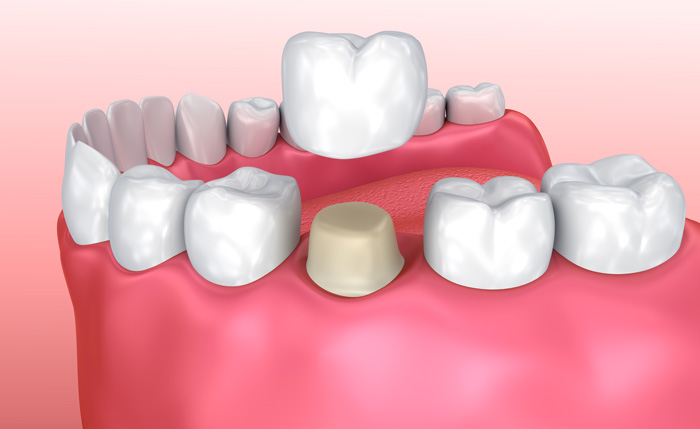 Grandville Mi Dental Crowns Dentist